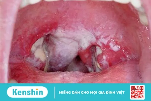 Đối tượng dễ nhiễm nấm họng ở người lớn là ai 1