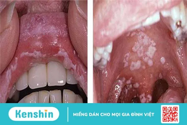 Nấm khoang miệng là bệnh gì? 1