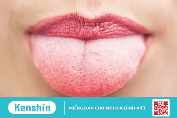 Nấm miệng bị đỏ thường gặp ở những đối tượng nào? Cách điều trị1