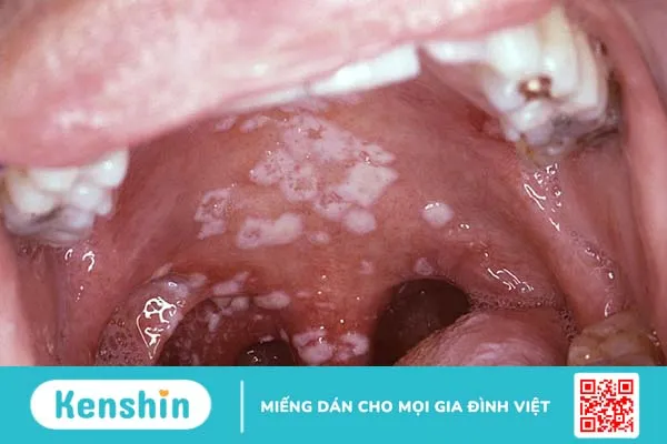 Nấm miệng có đau không? Nguyên nhân và cách điều trị nấm miệng 2