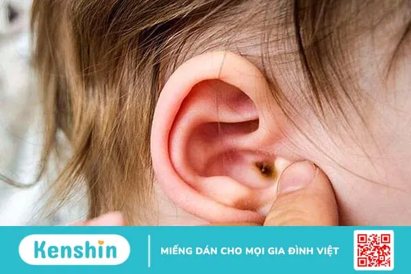 Nấm ống tai ngoài - Căn bệnh tưởng quen mà lạ! 1