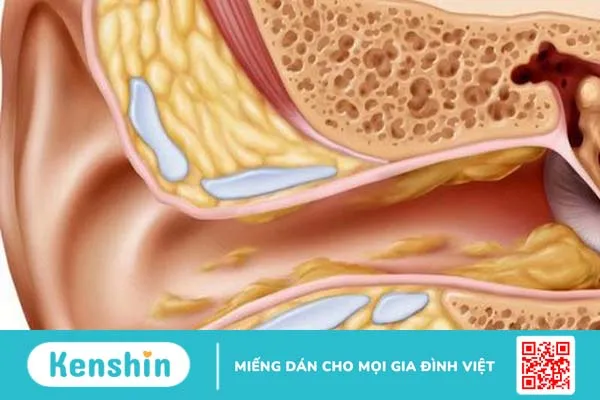 Nấm ống tai ngoài - Căn bệnh tưởng quen mà lạ! 2