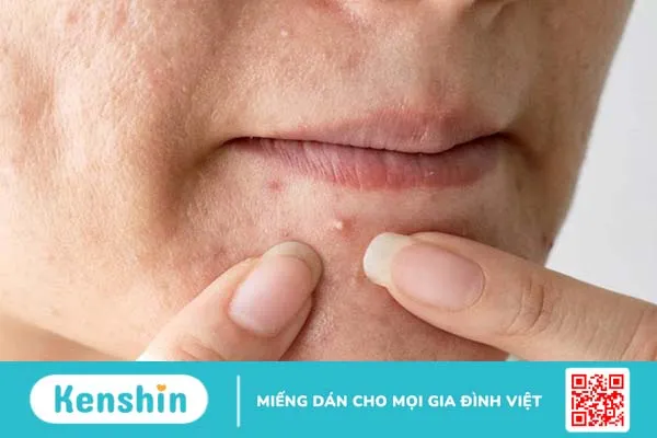 Nặn mụn xong bị lên mụn đầu trắng có sao không? 1