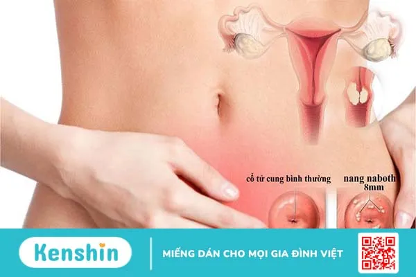 Nang naboth cổ tử cung 8mm có nguy hiểm không 1