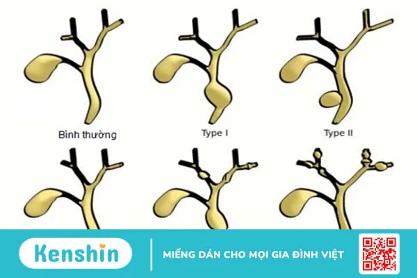 Nang ống mật chủ là gì? Phương pháp điều trị nang ống mật chủ 1