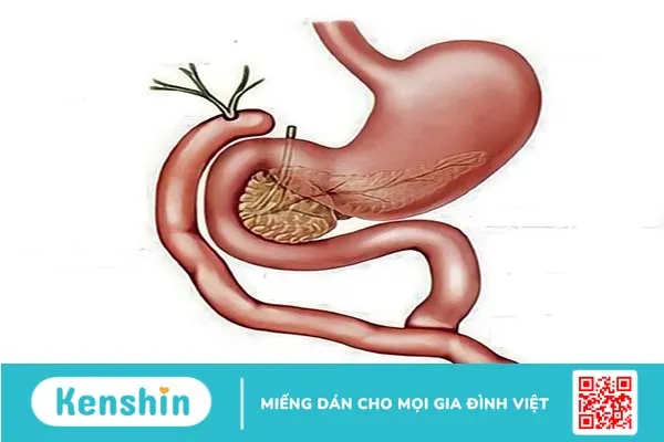 Nang ống mật chủ là gì? Phương pháp điều trị nang ống mật chủ 3