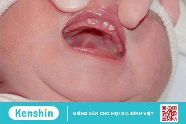 Nanh sữa ở trẻ sơ sinh có nguy hiểm không? Dấu hiệu và cách xử trí 1