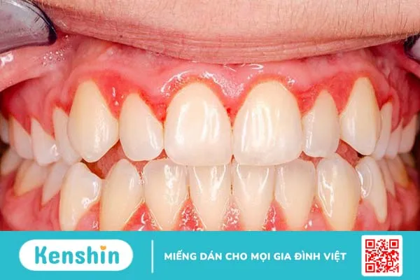 Bệnh viêm nướu không gây nguy hiểm và có thể điều trị triệt để