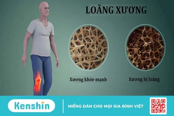 Nên dùng thuốc điều trị loãng xương trong bao lâu thì dừng lại? 1