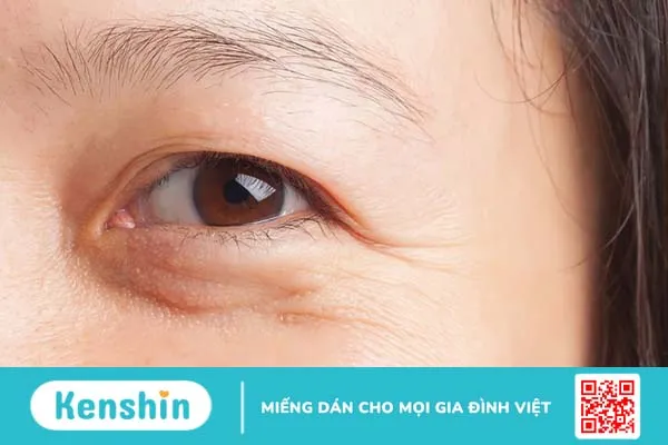 Nếp nhăn dưới mắt có dễ xóa không? Mẹo xóa nhăn vùng mắt hiệu quả 1