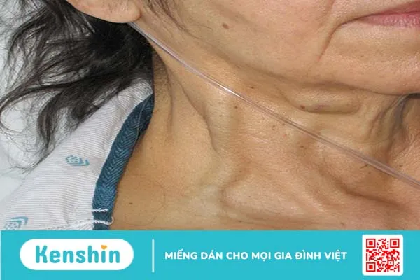 Nghiệm pháp phản hồi gan tĩnh mạch cổ được thực hiện khi nào? 3