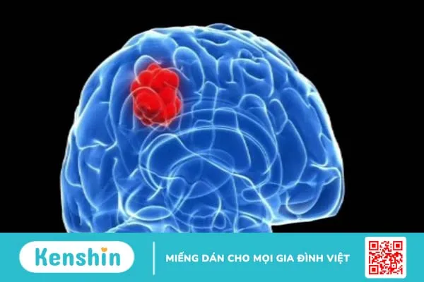 Chuyên ngành nào thuộc lĩnh vực ngoại thần kinh? Những bệnh lý nào được chỉ định khám và điều trị tại khoa phẫu thuật thần kinh? 1