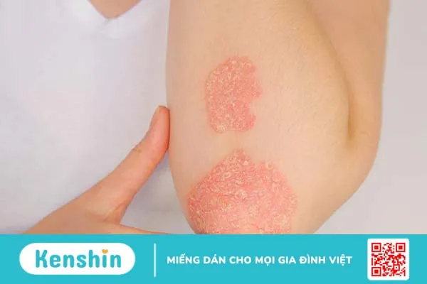 Ngứa khi mang thai: Nguyên nhân và cách điều trị 3