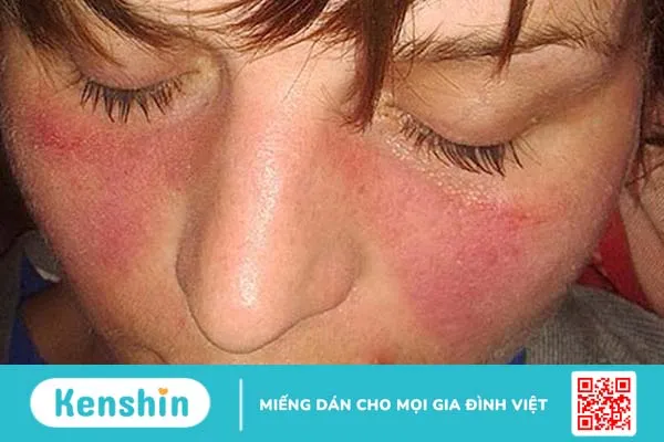 Người bệnh lupus ban đỏ ăn thịt bò được không? 1