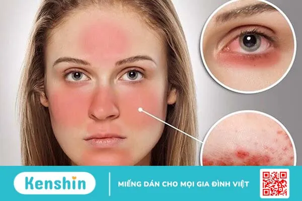 Người bệnh lupus ban đỏ ăn thịt bò được không? 2