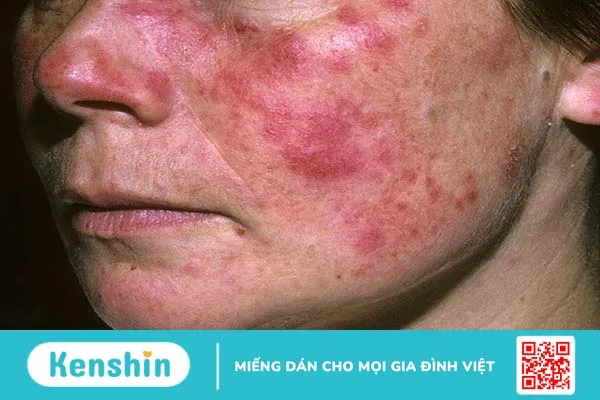 Người bị bệnh lupus ban đỏ nên kiêng ăn gì? 1