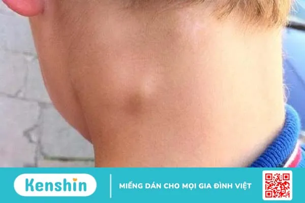 Người bị viêm hạch bạch huyết kiêng ăn gì? 2