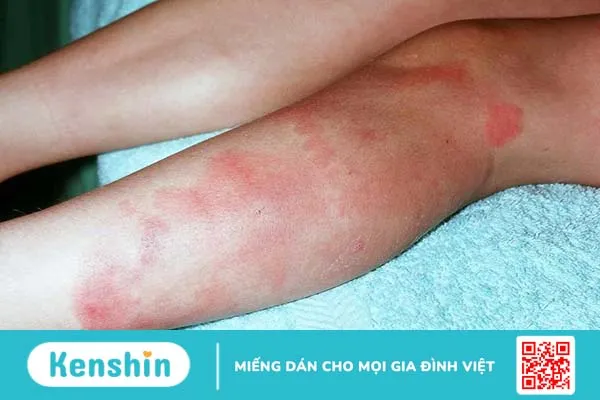 Người mắc bệnh hồng ban nút kiêng ăn gì là tốt nhất? 3