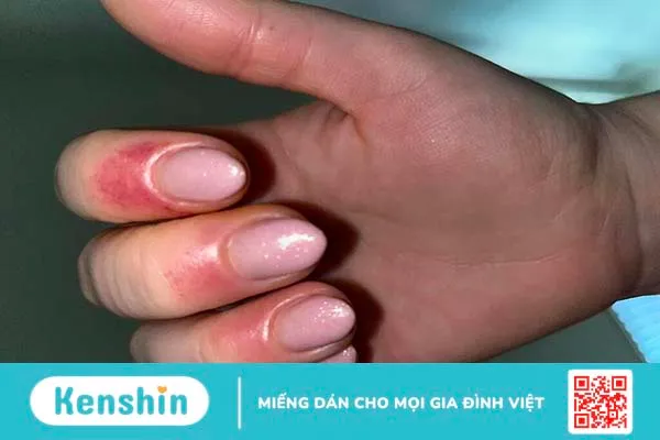 Nguyên nhân gây dị ứng sơn gel là gì? Cách xử trí dị ứng sơn gel như thế nào? 3