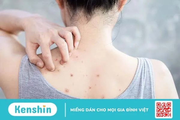 Nguyên nhân gây mụn nhọt ở lưng và cách điều trị 1