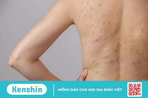 Nguyên nhân gây mụn nhọt ở lưng và cách điều trị 2