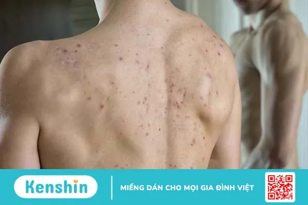 Nguyên nhân gây mụn nhọt ở lưng và cách điều trị 3