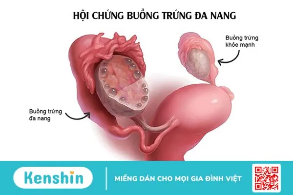 Nguyên nhân gây ra tình trạng rối loạn kinh nguyệt ở tuổi 17