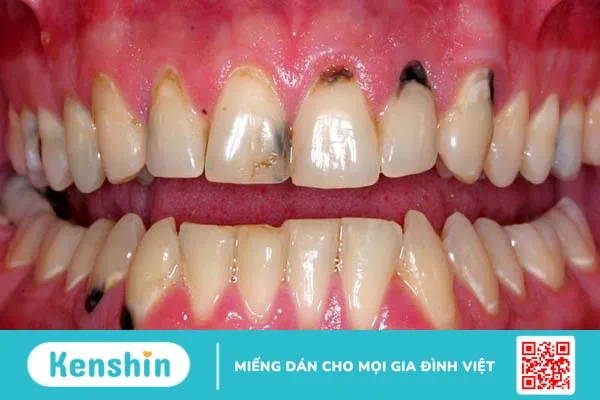 Khắc phục ngay tình trạng chân răng đen  -1