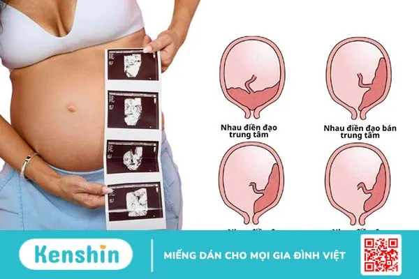 Các nguyên nhân mang thai 20 tuần bị ra máu và cách xử trí 1