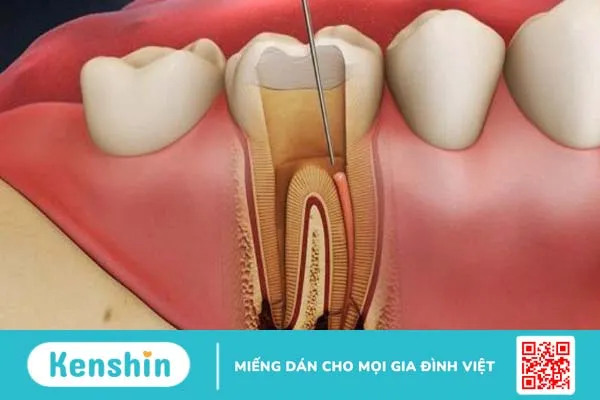 Nguyên nhân răng bọc sứ lâu năm bị đau nhức và cách xử lý 1