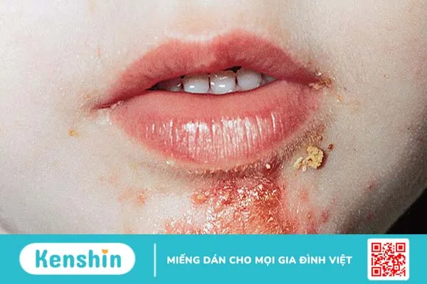 Nhận biết bệnh chốc lở ở trẻ sơ sinh và cách điều trị an toàn, hiệu quả 2