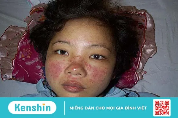 Lupus ban đỏ ở phụ nữ là một bệnh lý nguy hiểm, cần nhận biết bệnh sớm và có phương pháp điều trị đúng đắn 2