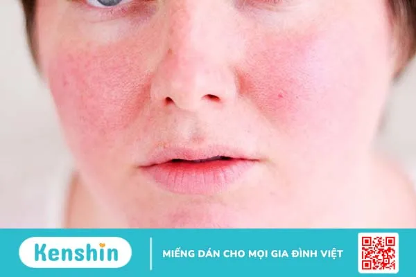 Nhận biết lupus ban đỏ ở phụ nữ và phương pháp điều trị 3