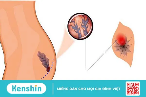 Bệnh trĩ ngoại cấp độ 1 là mức độ tình trạng bệnh nhẹ nhất nên không nhất thiết phải can thiệp bằng phẫu thuật