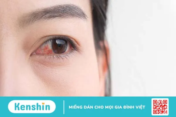 Nhãn viêm đồng cảm: Nguyên nhân, triệu chứng và cách điều trị 1