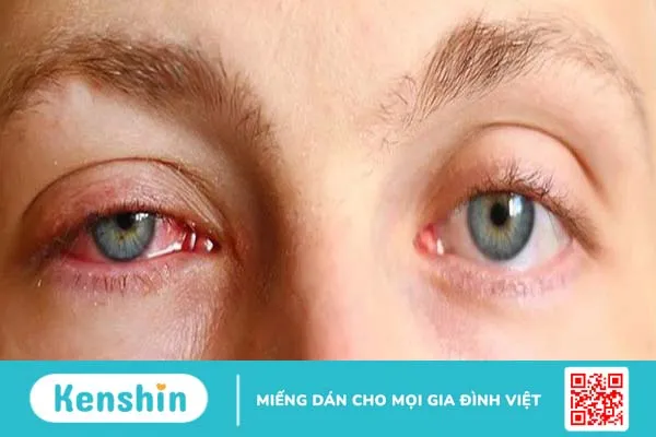 Nhãn viêm đồng cảm: Nguyên nhân, triệu chứng và cách điều trị 2