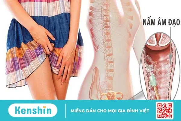 Nhiễm nấm âm đạo điều trị ra sao? 1