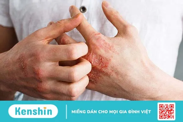 Nhiễm nấm có nghiêm trọng không?