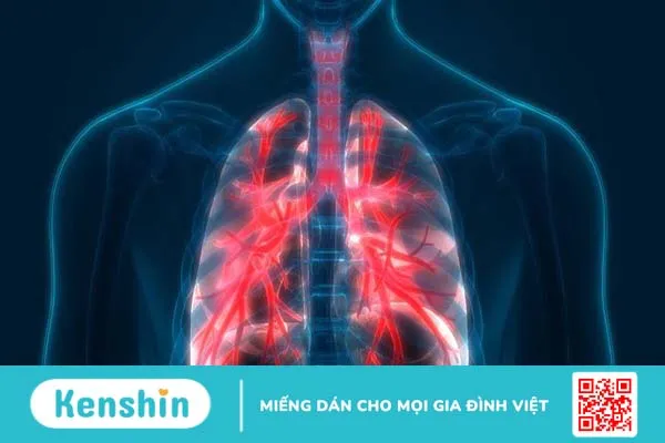 Nhiễm nấm Histoplasmosis: Dấu hiệu và điều trị 1