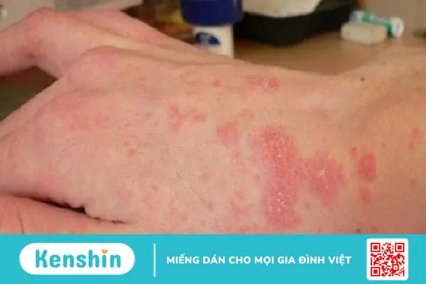 Nhiễm nấm Histoplasmosis: Dấu hiệu và điều trị 2