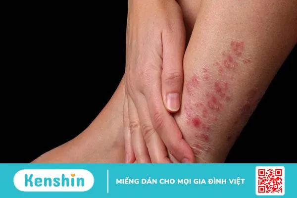 Nhiễm nấm Histoplasmosis: Dấu hiệu và điều trị 3