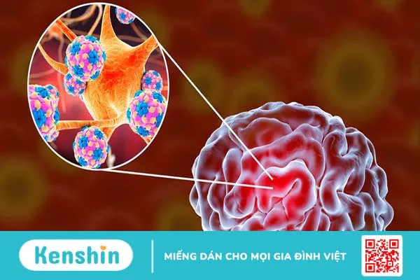 Nhiễm nấm Histoplasmosis: Dấu hiệu và điều trị 4