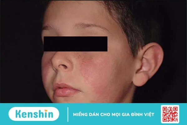 Nhiễm Parvovirus khi mang thai có ảnh hưởng đến thai nhi không? 2