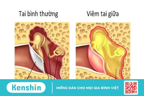 Nhiễm trùng tai cần được điều trị và phòng ngừa như thế nào? 1