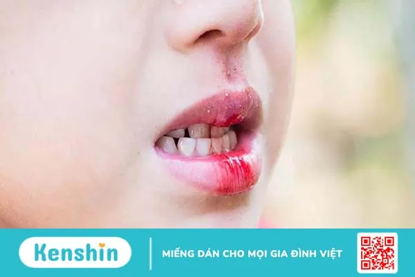 Nhiệt miệng chảy máu chân răng có sao không? Phòng ngừa bằng cách nào? 5