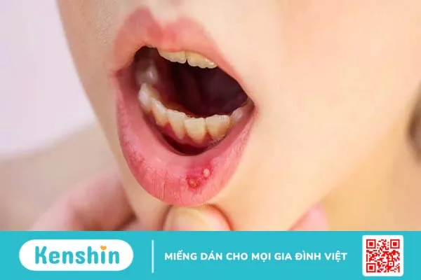 Nhiệt miệng ở trẻ em do nguyên nhân gì? Làm sao điều trị? 7