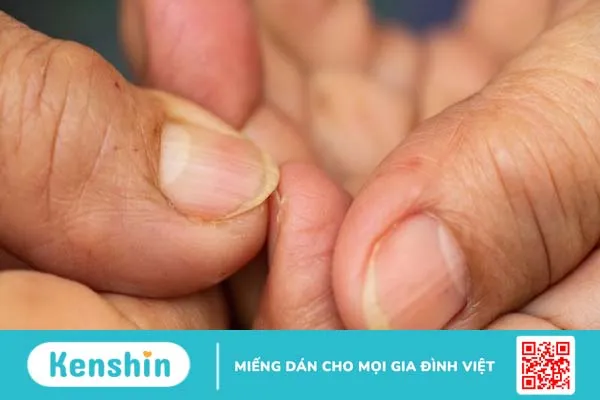 Nhìn móng tay đoán bệnh, bạn đã biết chưa? 1