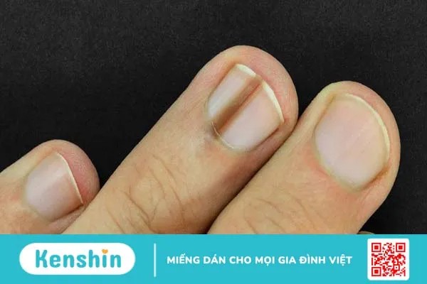 Nhìn móng tay đoán bệnh, bạn đã biết chưa? 2