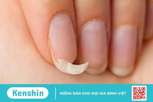 Nhìn móng tay đoán bệnh, bạn đã biết chưa? 3