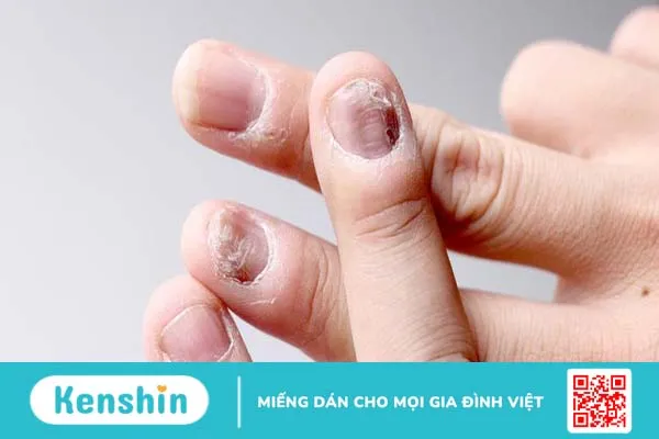 Nhìn móng tay đoán bệnh, bạn đã biết chưa? 4